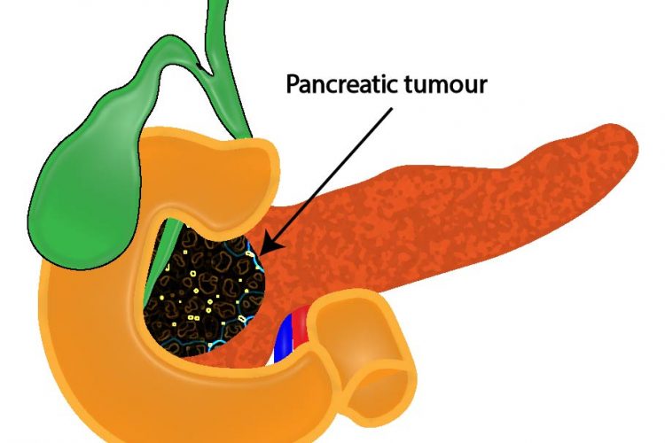 Dilated CBD, pancreatic carcinoma