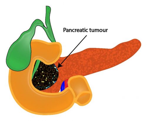 pancreatic cancer cbd