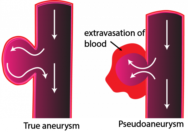 pseudoaneurysm-critical-care-sonography