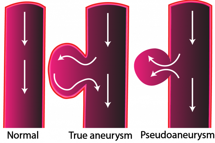 Pseudoaneurysm